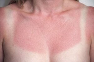4 naturlige midler mot solbrenthet