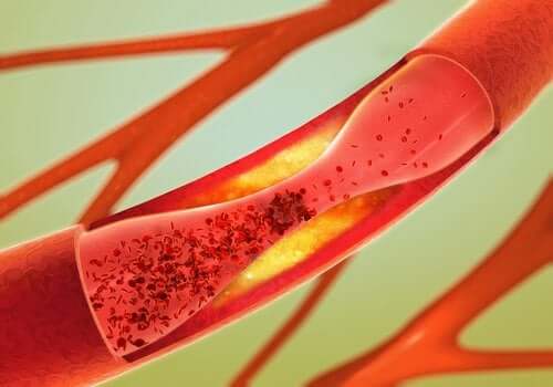 Hva er arteriosklerose?