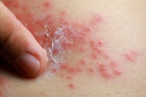 Fungerer behandling av psoriasis med tradisjonell kinesisk medisin?