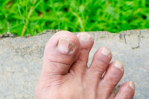 5 typer hudsopp og hvordan du identifiserer dem