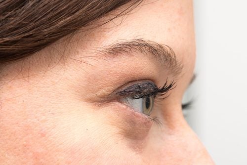 Mørke sirkler under øynene dine: årsaker og naturlig behandling