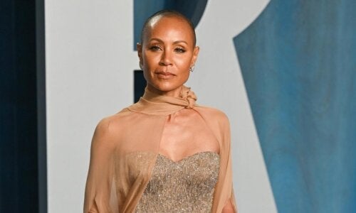 Alopecia Areata: Sykdommen som Jada Pinkett Smith har