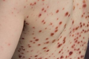 Apekopper: årsaker, symptomer, diagnose og behandling