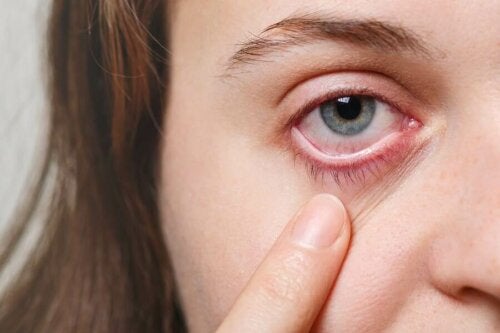 5 effektive naturlige midler mot øyeinfeksjoner