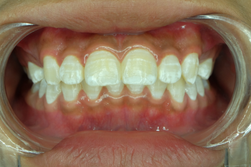 Hvite flekker på tennene: Hvorfor oppstår de?