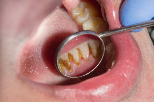 Hvorfor blir tannstein svart? Behandling og forebygging