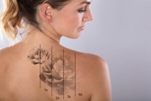 Hva er risikoen ved fjerning av tatoveringer med laser?