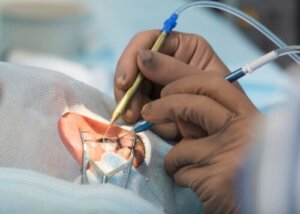 8 bivirkninger av kataraktkirurgi du bør vite om