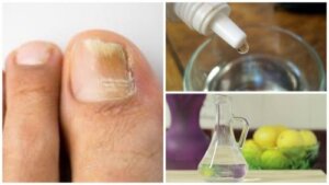 Lag din egen naturlige neglesoppfjerner
