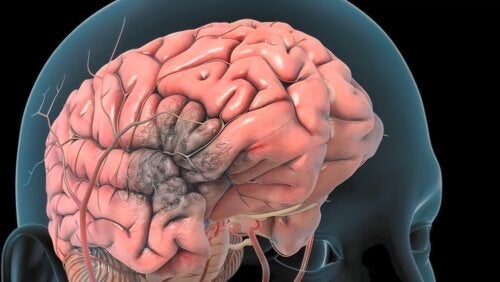 Cerebral venetrombose: hva det er, Ã¥rsaker, symptomer og behandling