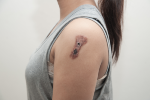 Plateepitelkarsinom: årsaker, symptomer og behandlinger