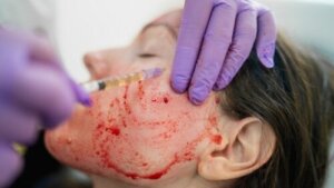 Vampyransiktsbehandlingen: Hva er det og hva er risikoen?