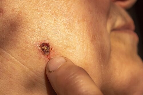 Basalcellekarsinom: Den vanligste hudkreften