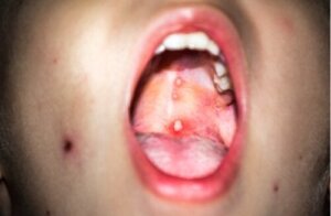 Gingivostomatitt hos barn: hva det er og hva du skal gjøre med det