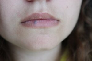 Leppekreft: årsaker, symptomer og behandlinger