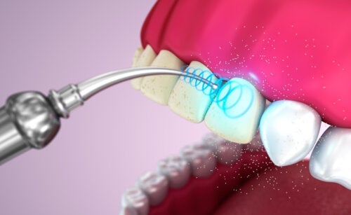 Ultralyd-tannrengjøring: fordelene og ulempene