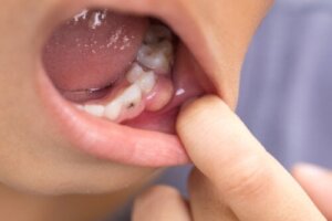 Symptomer på en tanninfeksjon som har spredt seg til kroppen
