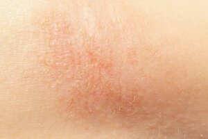 7 naturlige midler mot tørr hud