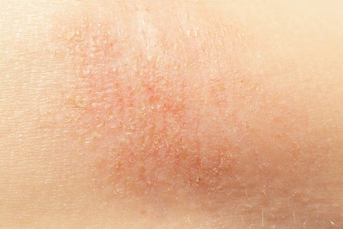 6 naturlige midler mot tørr hud