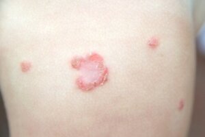 Impetigo hos barn