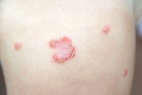 Impetigo hos barn