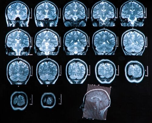 Hjerneabscess: Diagnose og behandling