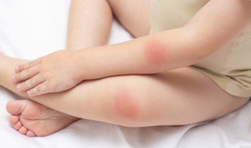 Røde flekker på huden: 25 mulige årsaker og behandlinger