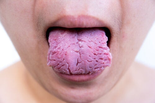 Sprukket tunge: årsaker og behandling
