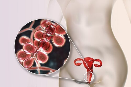 Gul vaginal utflod: 5 årsaker og behandling