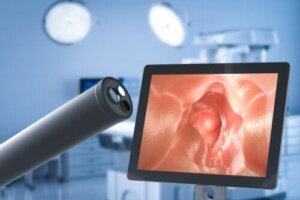 Kirurgien for å behandle gastroøsofageal reflukssykdom