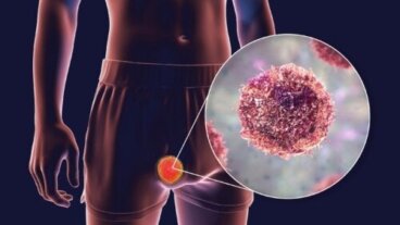 Teratomasvulster: typer, symptomer og behandling