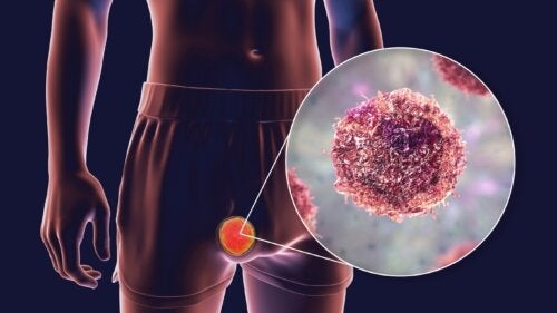 Teratomasvulster: typer, symptomer og behandling