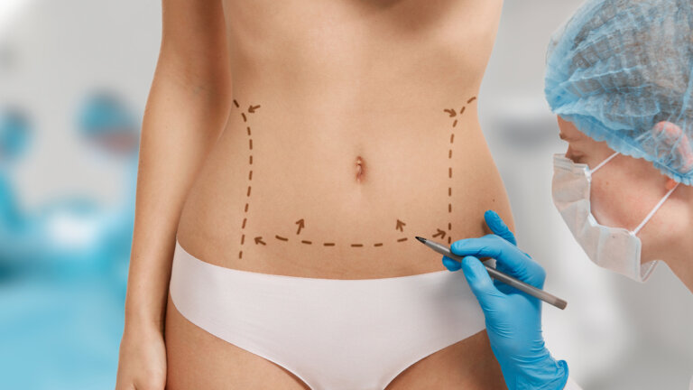 Når dekkes bukplastikk av det offentlige helsevesenet?