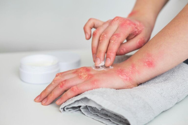 Stressutløst psoriasis: hva det er, årsaker og hvordan man identifiserer det